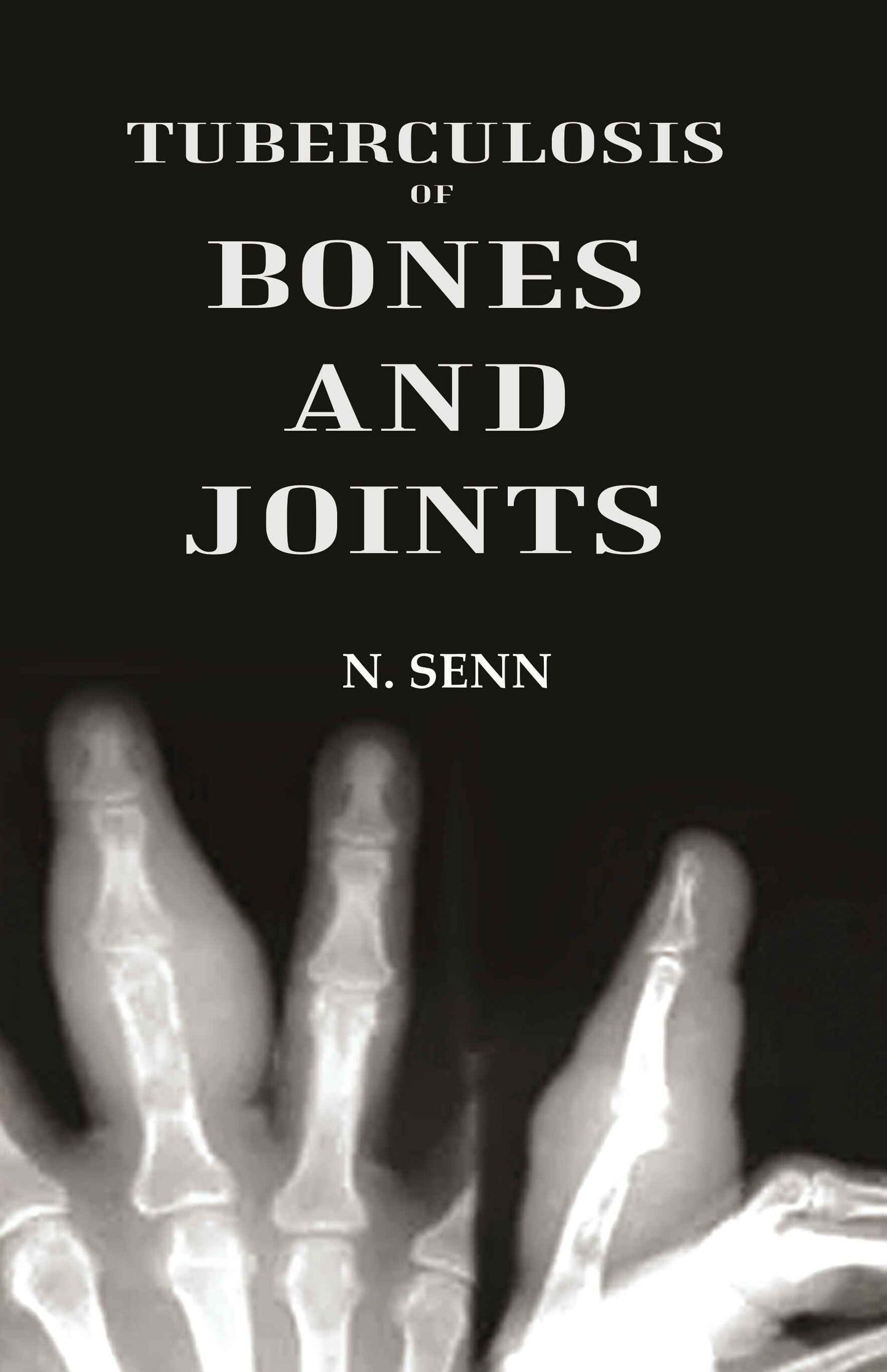 Tuberculosis of Bones and Joints - Gyan Books