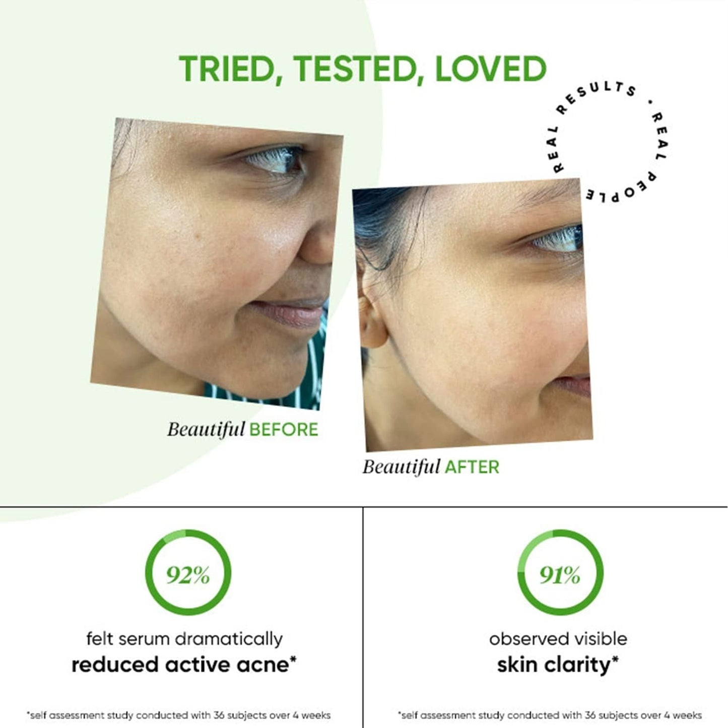 Dot & Key 2% Salicylic + Zinc Acne Busting Face Serum For Acne & Oil Control